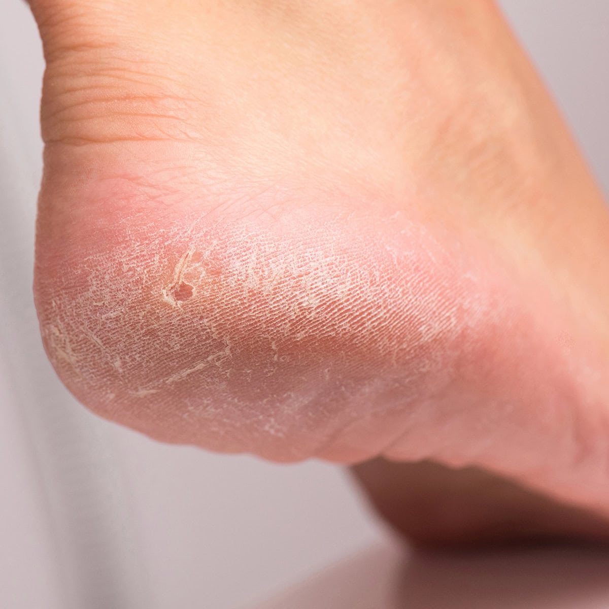 podologie hornhaut entfernen lassen rueti