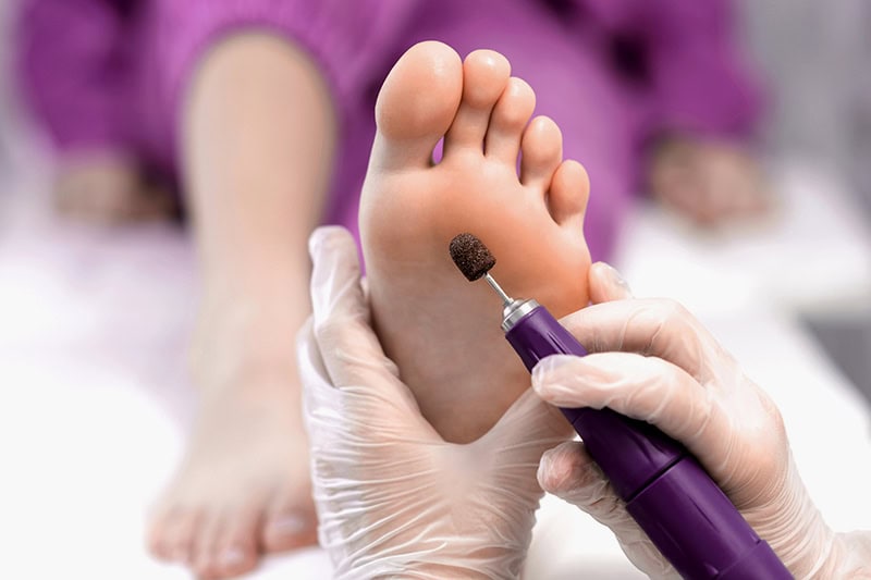 podologin hornhaut entfernen lassen