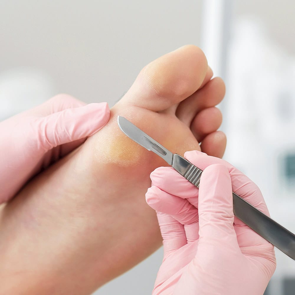 schwielen entfernen lassen rueti