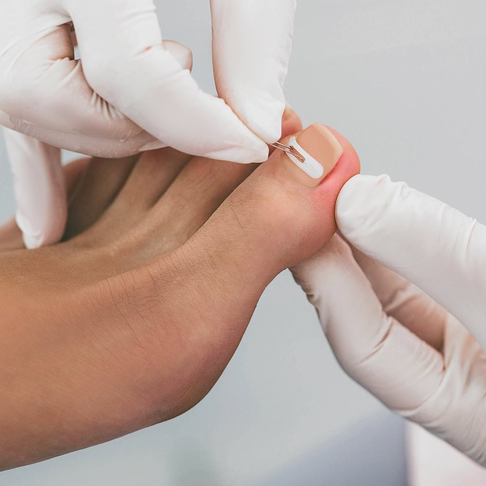 spangentechniken podologie