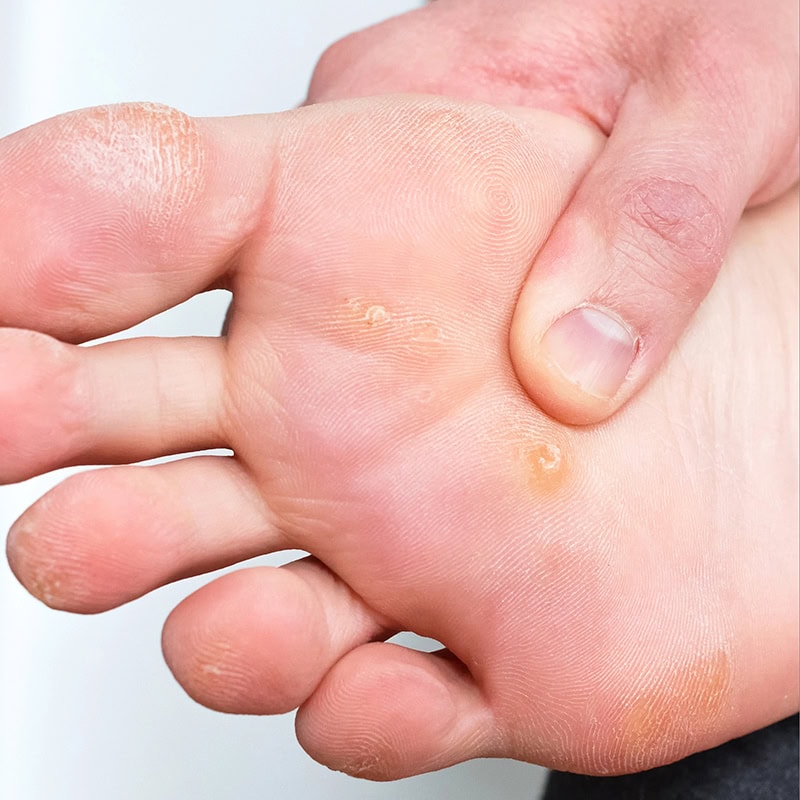 huehneraugen entfernen podologie straessle