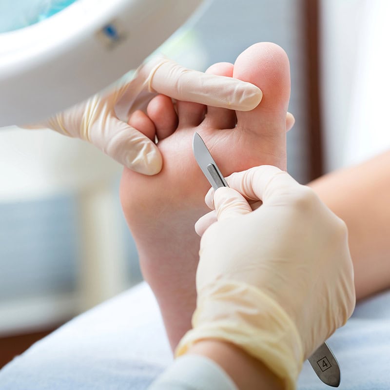 podologie judith straessle schwielen entfernen lassen